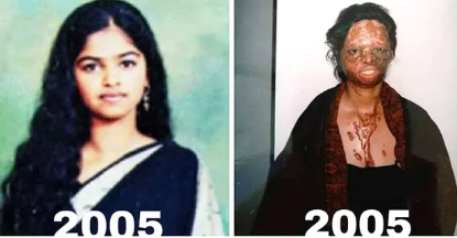 Laxmi Agarwal - Before vs After Acid Attack
